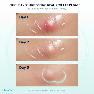 Orvele™ Hydrocolloid Roll