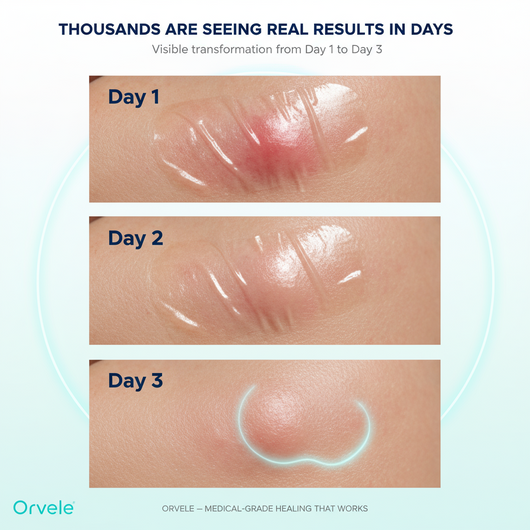 Orvele™ Hydrocolloid Roll