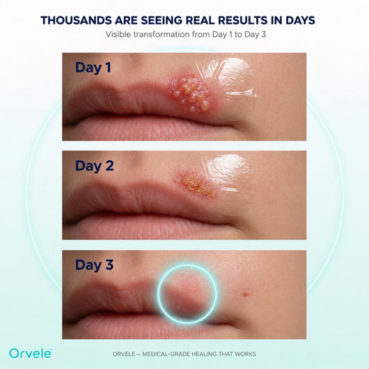 Cold sore covered with the hydrocolloid patch, day 1 to day 3