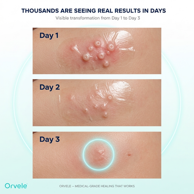 Orvele™ Hydrocolloid Roll For Molluscum