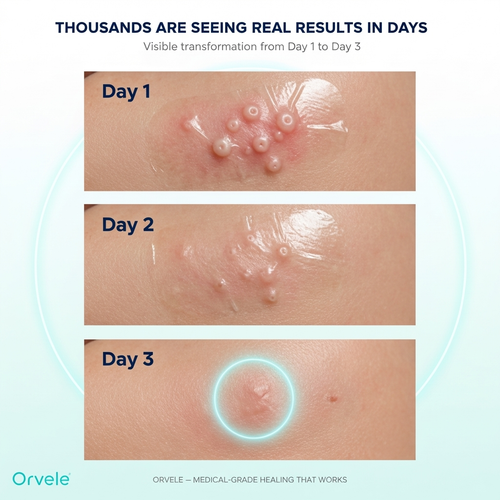 Orvele™ Hydrocolloid Roll For Molluscum